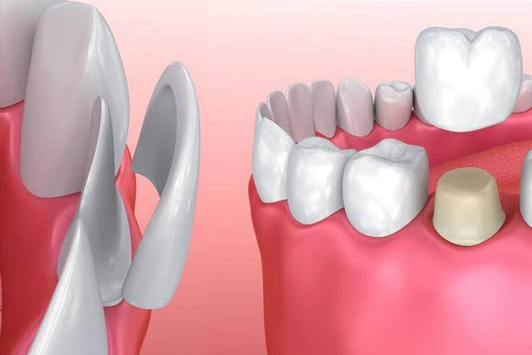 Dental Crown & Laminate Veneers