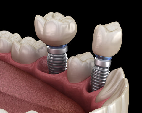 Dental Implant FAQs