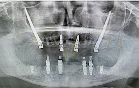 Zygomatic Implants in Turkey
