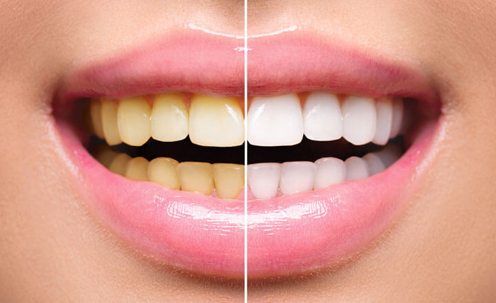 Teeth Whitening & Bleaching