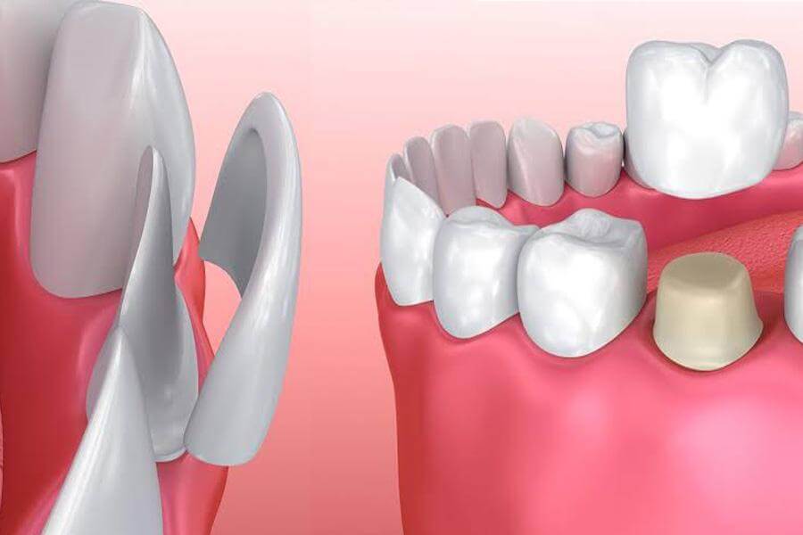 Dental Crown & Laminate Veneers