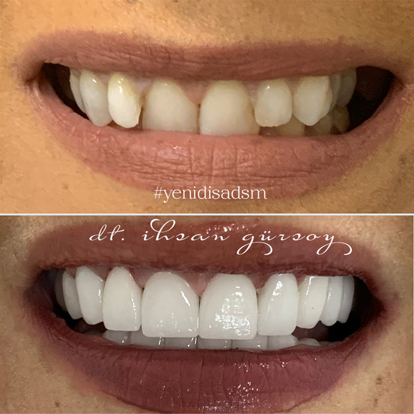 After treatment